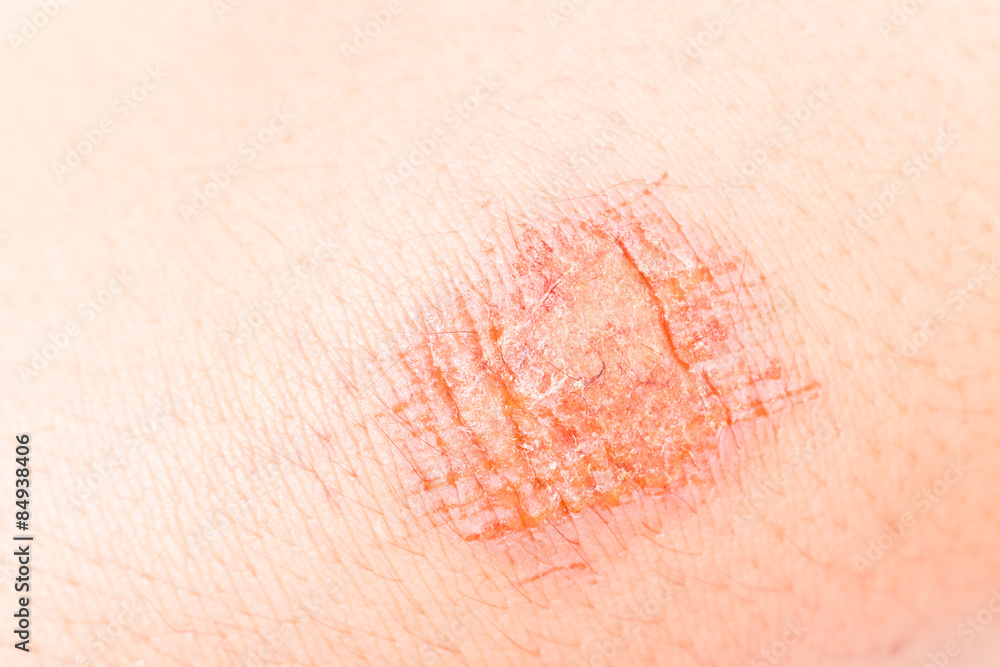 Fototapeta premium Close up on painful bruise wound on the knee