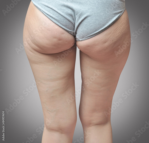 Fotografie Cellulite at woman buttocks.Gray background
