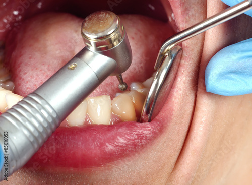 Wallpaper Mural The dentist inserts the swab Torontodigital.ca