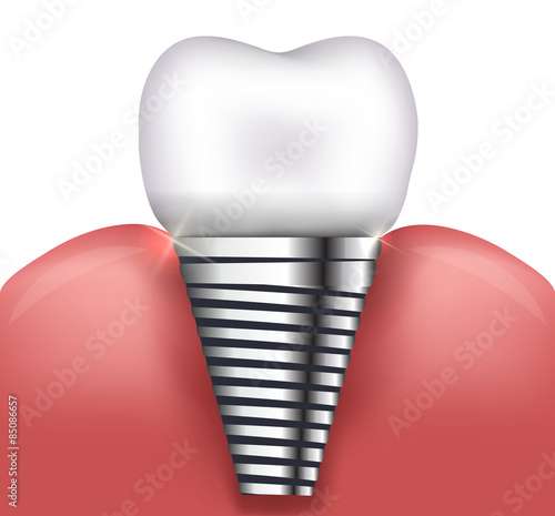 Dental implant