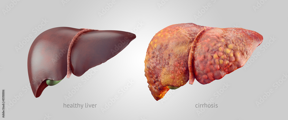 Realistic illustration of healthy and sick human livers - obrazy, fototapety, plakaty 