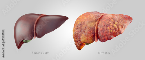Realistic illustration of healthy and sick human livers photo