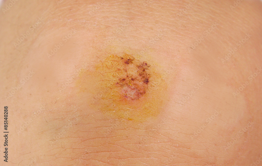 Fototapeta premium Closeup of a wound or scrapped knee
