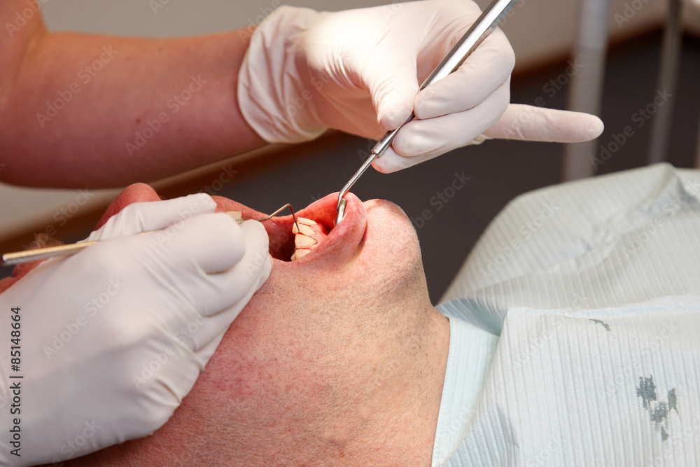 close up of a man getting his teeth checked by the hygienist close up of a man getting his teeth checked by the hygienist