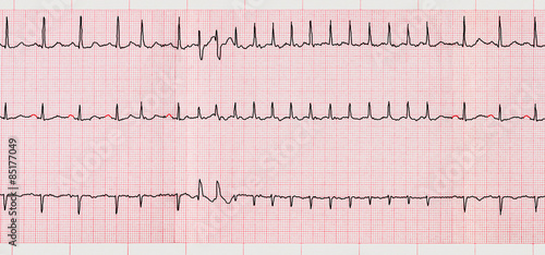 Foto ECG with supraventricular arrhythmias