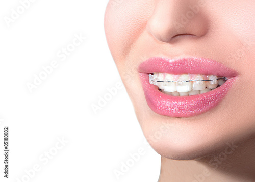Closeup Ceramic Braces on Teeth. Beautiful Female Smile with Braces. Orthodontic Treatment. Dental care Concept. B.