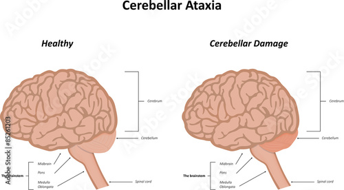 Cerebellar Ataxia photo