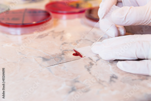 Laboratory doctor preparing for a blood smear test or blood film. Two slides and a drop of blood and petri dishes in the background photo