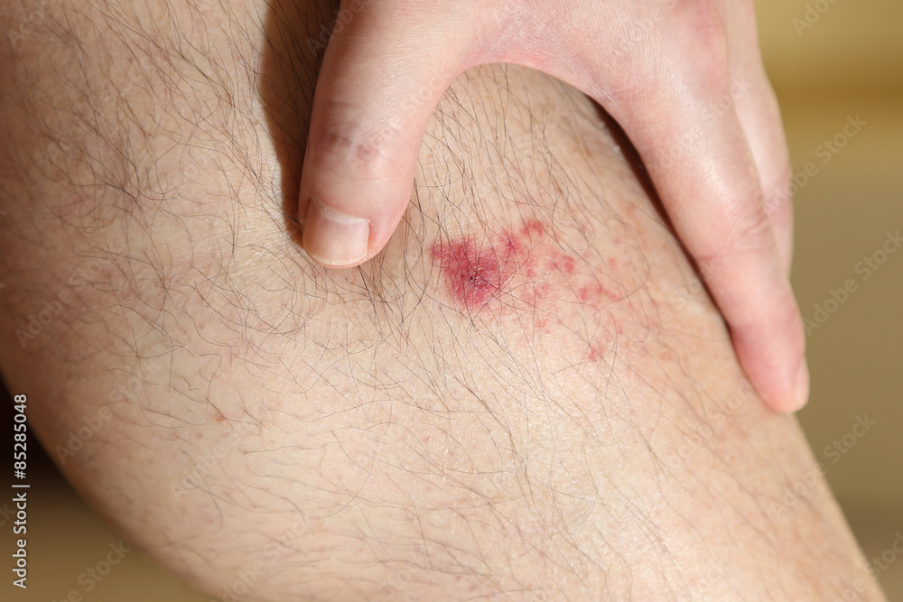 The wound on man's leg The wound on man's leg