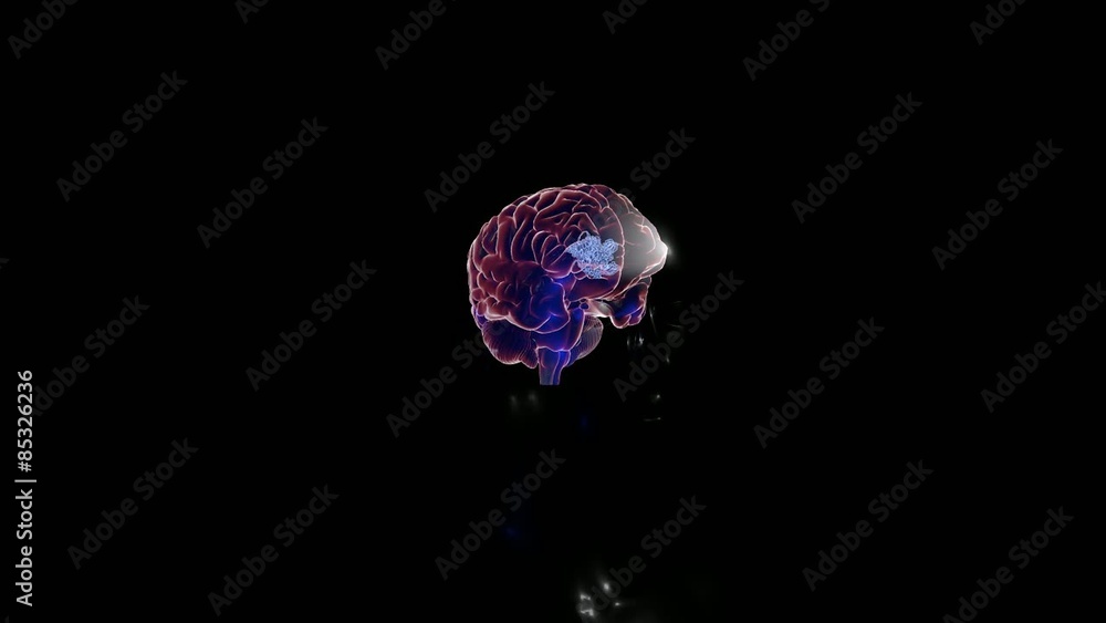 3D medical animation explaining Glioblastomas: tumors that arise from astrocytes. Part3 3D medical animation explaining Glioblastomas: tumors that arise from astrocytes. Part3