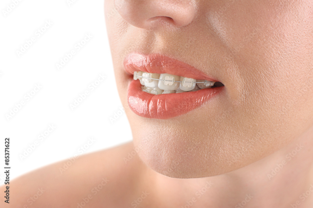 Fototapeta premium Teeth alignment. Braces. Beautiful woman smiling.
