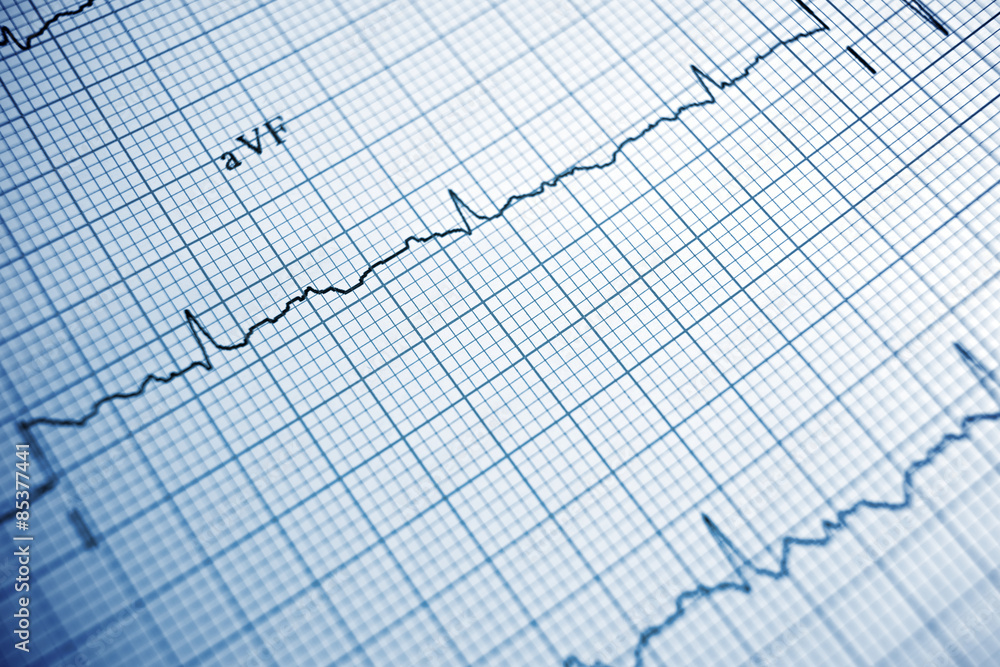 Electrocardiogram Electrocardiogram