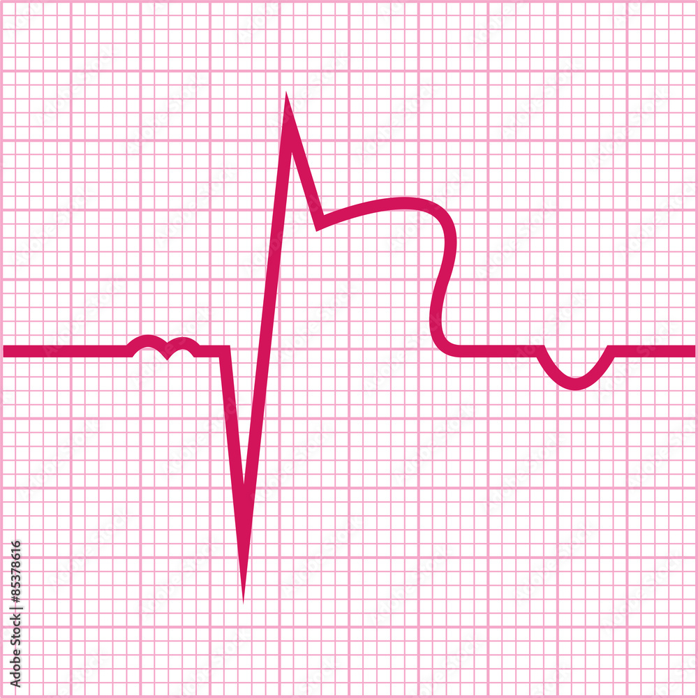 Myocardial Infarction Vector Ecg Stock Vector Adobe Stock