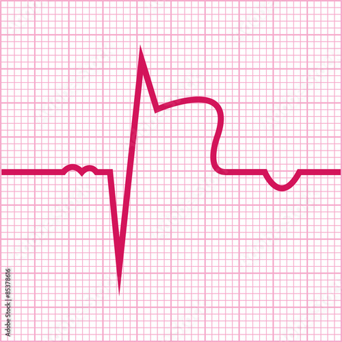 Myocardial infarction vector ECG