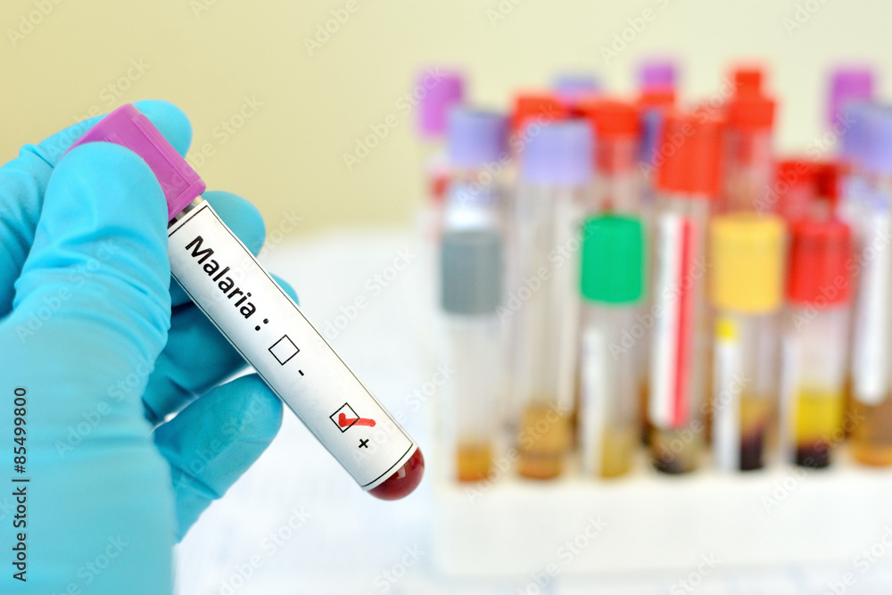 Fototapeta premium Malaria positive