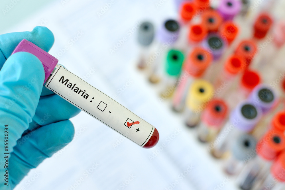 Obraz premium Malaria positive