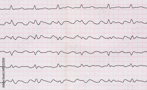 ECG with paroxysm correct form of atrial flutter 