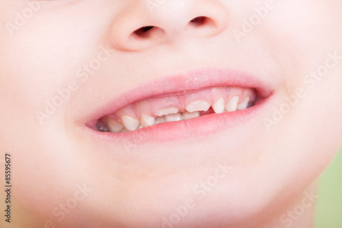 Closeup of child mouth with new teeth growing