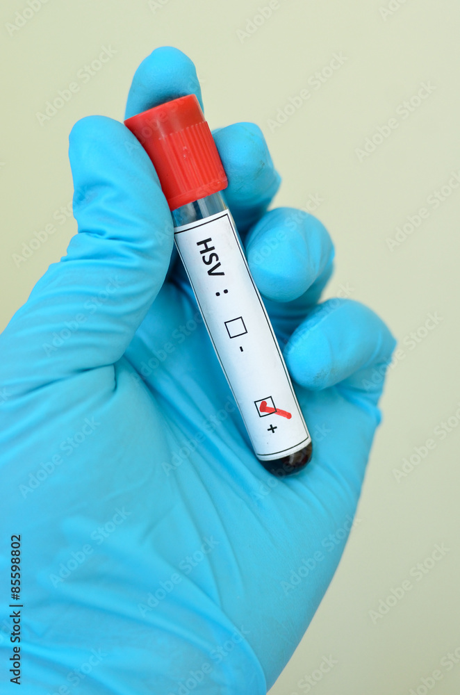 Obraz premium Blood sample with HSV (Herpes Simplex Virus) positive