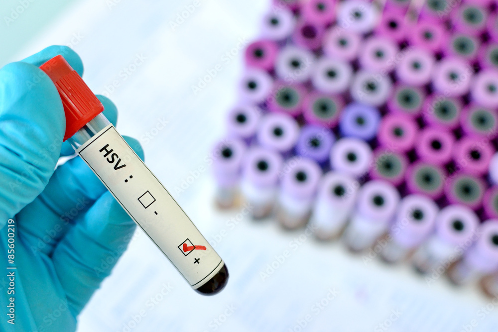 Blood sample with HSV (Herpes Simplex Virus) positive Stock Photo