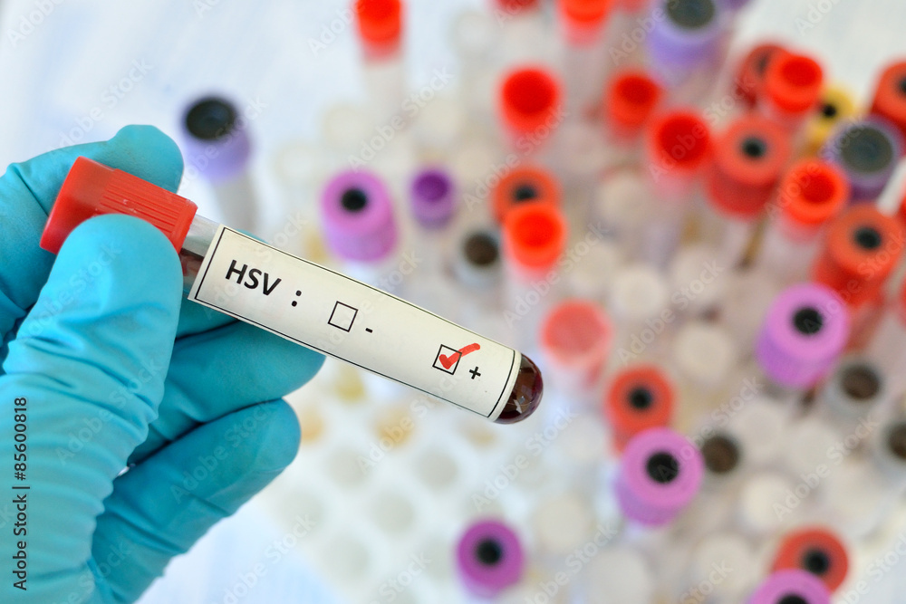 Obraz premium Blood sample with HSV (Herpes Simplex Virus) positive