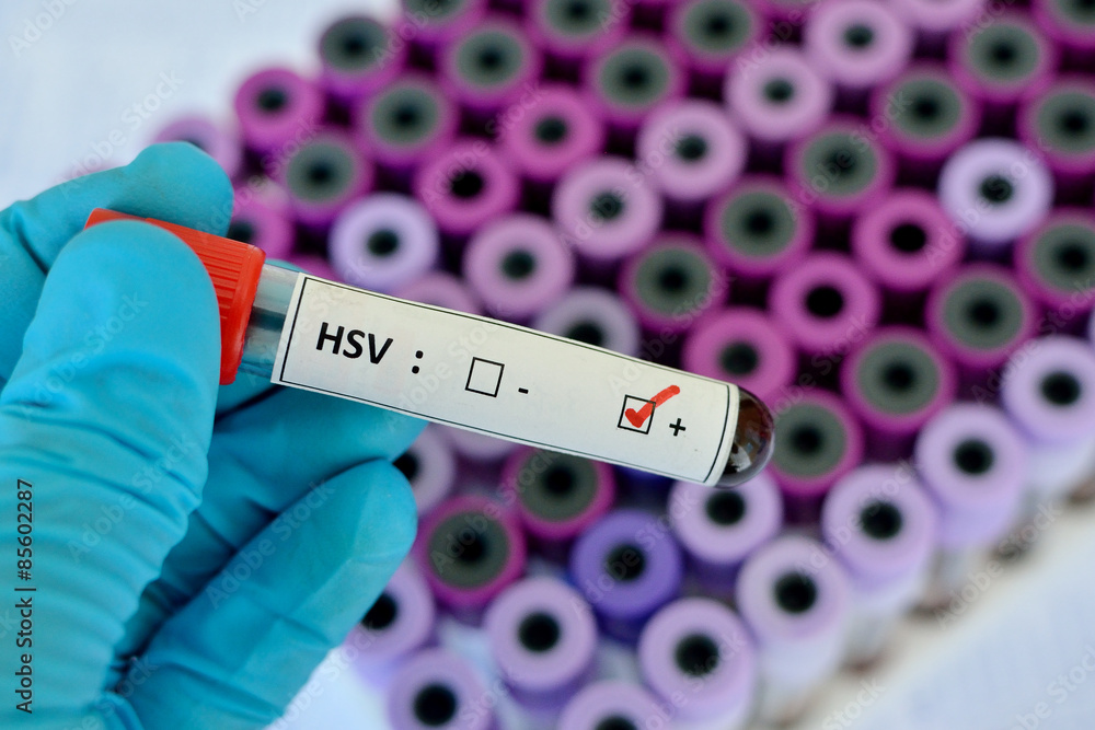 Obraz premium Herpes positive