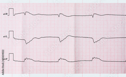 Фотография Tape ECG after clinical death and a successful resuscitation
