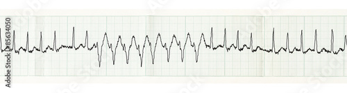 Photos ECG with paroxysm of atrial fibrillation