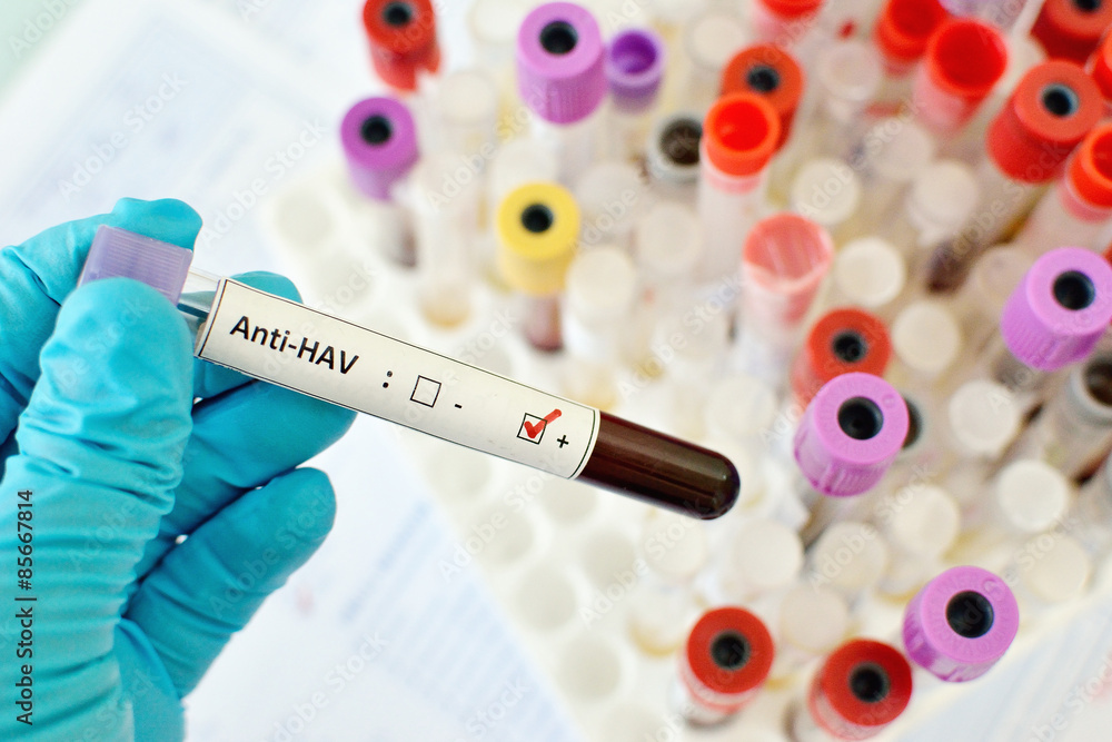 Fototapeta premium Hepatitis A virus (HAV) positive