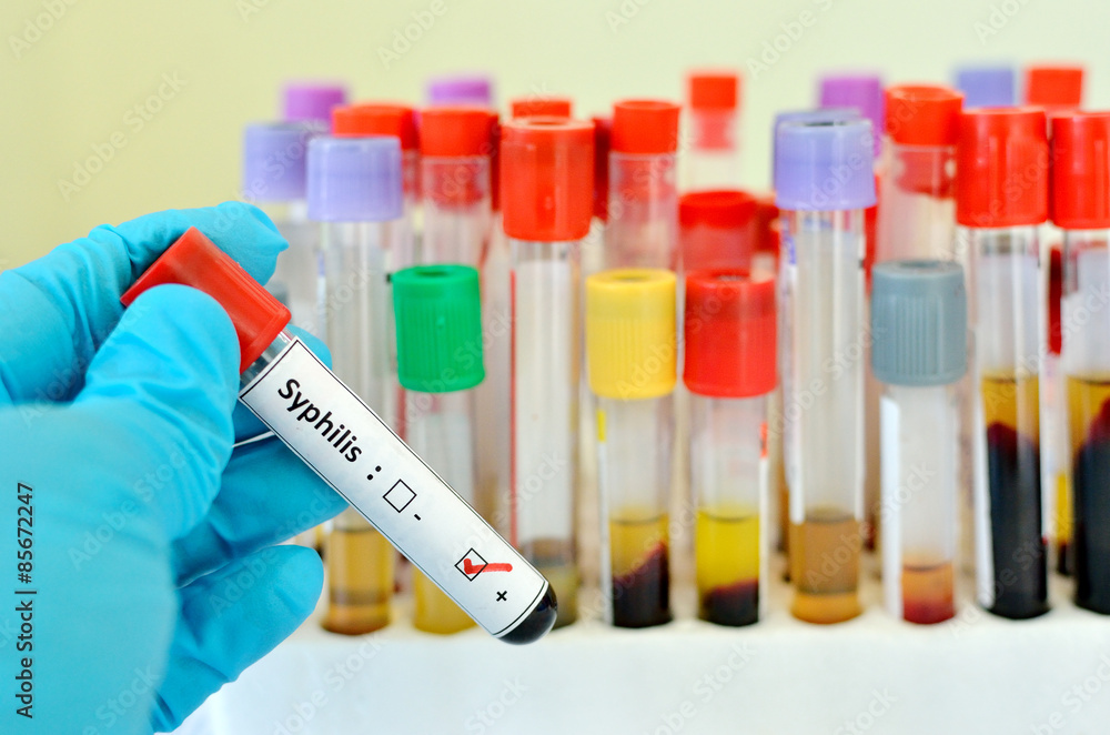 Blood sample with syphilis (Treponema Pallidum) positive Blood sample with syphilis (Treponema Pallidum) positive