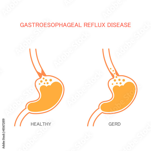 reflux  disease, heartburn, stomach pain, human gastric acid 
