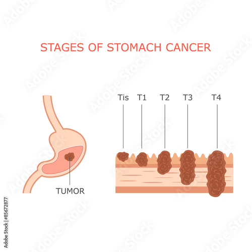 stomach cancer stages, human gastric tumor anatomy, digestive system, 