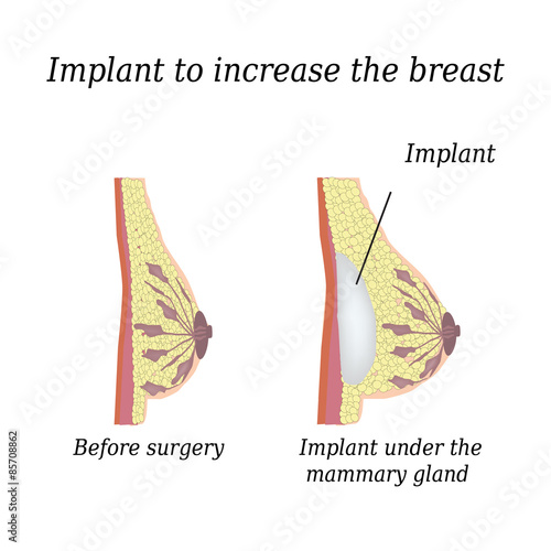 The implant in the breast on an isolated background