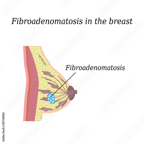 Fibroadenomatosis chest. On isolated background. The structure