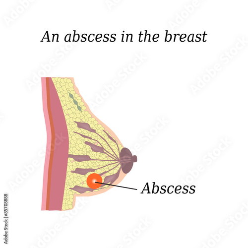 An abscess in the chest. On isolated background. The structure