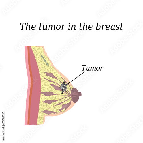 The tumor in the breast. On isolated background. The structure