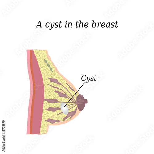 A cyst in the breast. On isolated background. The structure of