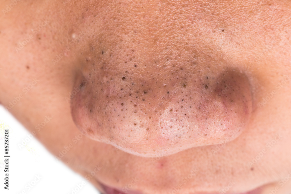 Close up pimple blackheads on the nose of a teenager Close up pimple blackheads on the nose of a teenager