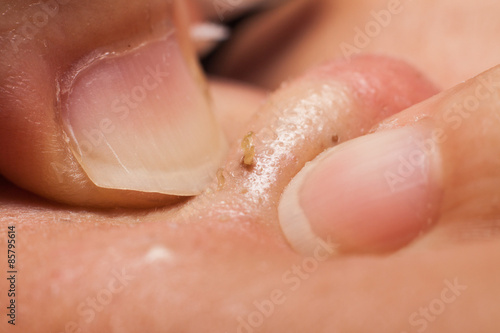Squeezing pimple blackheads from nose of teenager using finger nails