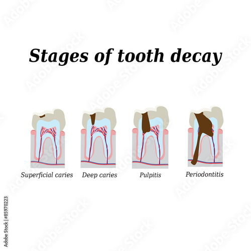 Stages of development of dental caries. Vector illustration on