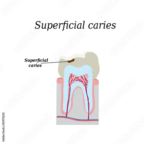 Home tooth caries. Vector illustration on isolated background