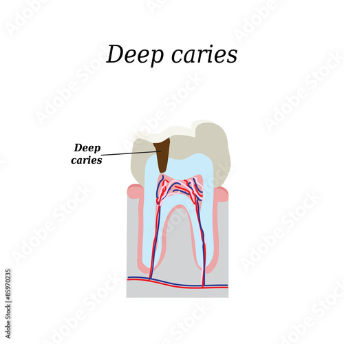 Deep tooth decay. Vector illustration on isolated background