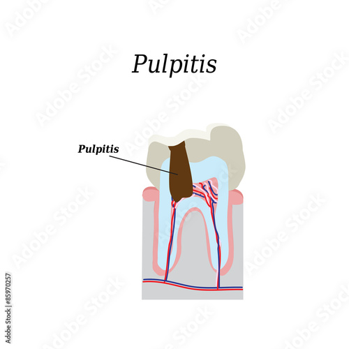 Dental pulp. Vector illustration on isolated background