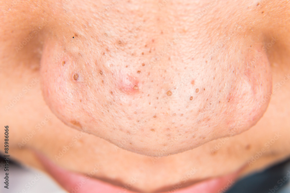 Ugly pimples, acne, zit and blackheads on the nose of a teenager Ugly pimples, acne, zit and blackheads on the nose of a teenager