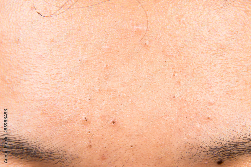 Fototapeta premium Pimples, acne, zit and blackheads on forehead of a teenager