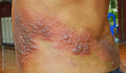 Symptom inflected herpes zoster virus.  photo