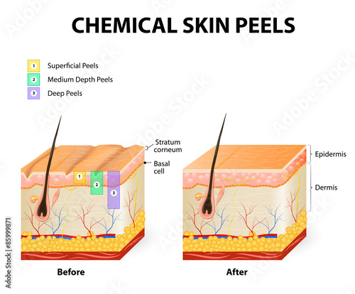 chemical peels photo