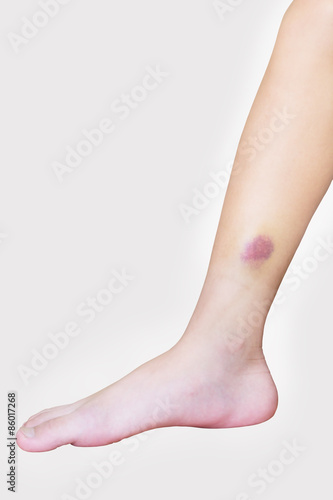 Bruise leg on white background