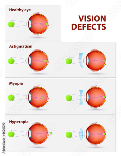 Astigmatism, Myopia and Hyperopia