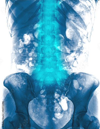 Obraz na plátně Lumbar spine of woman and inflammation at lumbar spine ( low back pain ) ( X-ray